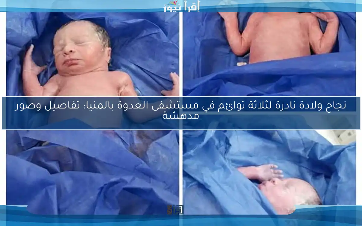 نجاح ولادة نادرة لثلاثة توائم في مستشفى العدوة بالمنيا: تفاصيل وصور مدهشة